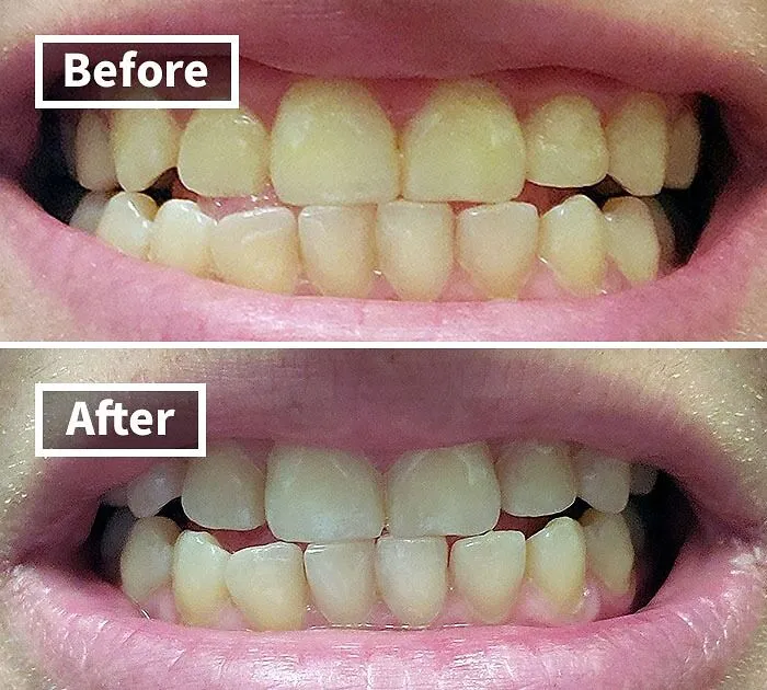 Brighten Your Smile In A Flash With The     <a Style="Display:inline;" Href="Https://Www.amazon.com/Venus-Visage-Effective%ef%bc%86painless-Sensitivity-Travel-Friendly/Dp/B082x2gsgj?ie=utf8&linkcode=ll1&tag=bpcrab-20&linkid=9224978d3cb19a63b85bf0e441a22b60&language=en_us&ref_=as_li_ss_tl" Target="_blank"><a Style="Display:inline;" Href="Https://Www.amazon.com/Venus-Visage-Effective%ef%bc%86painless-Sensitivity-Travel-Friendly/Dp/B082x2gsgj?ie=utf8&linkcode=ll1&tag=bpcrab-20&linkid=9224978d3cb19a63b85bf0e441a22b60&language=en_us&ref_=as_li_ss_tl" Target="_blank"><span Style="Font: Inherit; Color: #d74b1f;"> Venus Visage Teeth Whitening Pen</Span>, A Convenient, Portable Powerhouse That Whitens And Shine Teeth With Just A Few Easy Applications