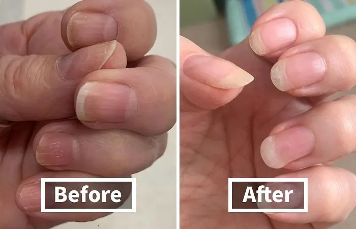Nourish Your Nails Back To Health With The   <a Style="Display:inline;" Href="Https://Www.amazon.com/Hoof-Strengthening-Coconut-Strengthener-Growth/Dp/B071yt177r?ie=utf8&linkcode=ll1&tag=bpcrab-20&linkid=12283ba51b0da751ad61553fcb44dab8&language=en_us&ref_=as_li_ss_tl" Target="_blank"><span Style="Font: Inherit; Color: #d74b1f;"> Nail Strengthener And Nail Growth Cream</Span>, A 2-In-1 Treatment That Fortifies And Grows Your Nails, Leaving Them Stronger, Longer, And More Resilient