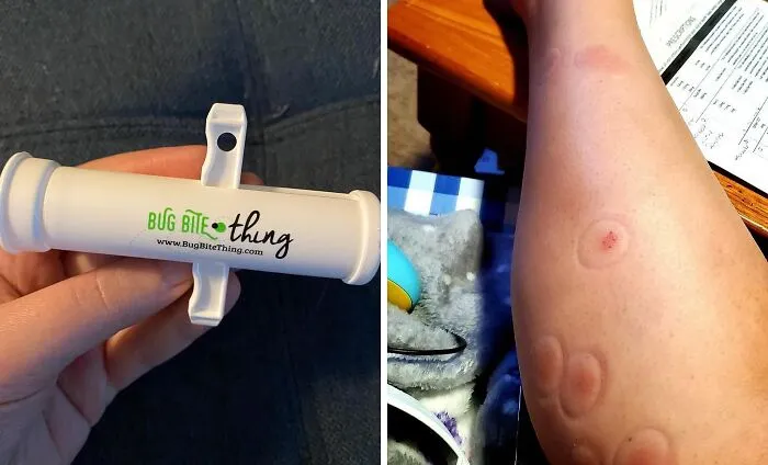 Suck It Up, Bug Bites! Banish Those Pesky Itchy Bumps With This Genius   <a Style="Display:inline;" Href="Https://Www.amazon.com/Bug-Bite-Thing-Suction-Remover/Dp/B01576dwqu?ie=utf8&linkcode=ll1&tag=bpgnu-20&linkid=f1ba3b0400f8a182cccaa1077a5dade6&language=en_us&ref_=as_li_ss_tl" Target="_blank"><span Style="Font: Inherit; Color: #d74b1f;"> Bug Bite Thing Suction Tool </Span> - A Weirdly Wonderful Way To Remove Insect Bites And Leave Your Skin Serene