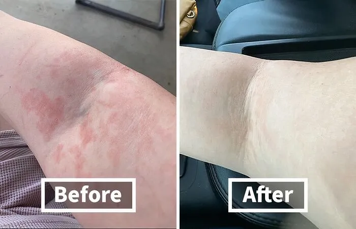 Rashes Got You Feeling Like You're Auditioning For A Horror Movie? This   <a Style="Display:inline;" Href="Https://Www.amazon.com/Dp/B00yi2s0p8?ascsubtag=7638669%2c13%2c28%2cd%2c0%2c0%2c0%2c900%3a2%3b974%3a3%3b1125%3a1%3b1338%3a1%3b1352%3a1%2c44342087%2c0%2c0%2c0&btn_ref=srctok-E71841a61e9a137a&linkcode=ll1&tag=bpmonkey-20&linkid=fe22902ec26cc3359cb8317ab2e00093&language=en_us&ref_=as_li_ss_tl" Target="_blank"><span Style="Font: Inherit; Color: #d74b1f;"> Fast Acting Rash Cream</Span> Will Soothe That Itchy Skin And Have You Feeling Comfortable In Your Own Skin Again 