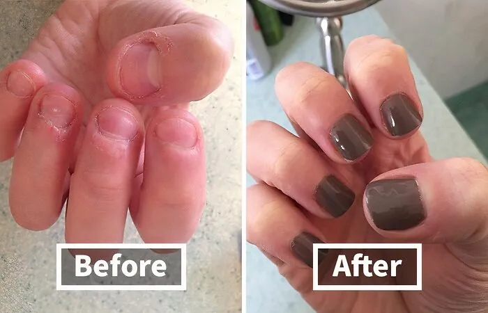 Nail-Biting Habit Got Your Fingers Looking Like They Lost A Fight With A Cheese Grater? This   <a Style="Display:inline;" Href="Https://Www.amazon.com/Dp/B0000yuxi0?ascsubtag=7638669%2c16%2c28%2cd%2c0%2c0%2c0%2c900%3a2%3b974%3a3%3b1125%3a1%3b1338%3a1%3b1352%3a1%2c44342089%2c0%2c0%2c0&btn_ref=srctok-Ee5d319209466386&linkcode=ll1&tag=bpmonkey-20&linkid=f9e3e41c1b0a2c05555082f6c54bf642&language=en_us&ref_=as_li_ss_tl" Target="_blank"><span Style="Font: Inherit; Color: #d74b1f;"> Nail Care Treatment </Span> Will Help You Kick That Habit To The Curb