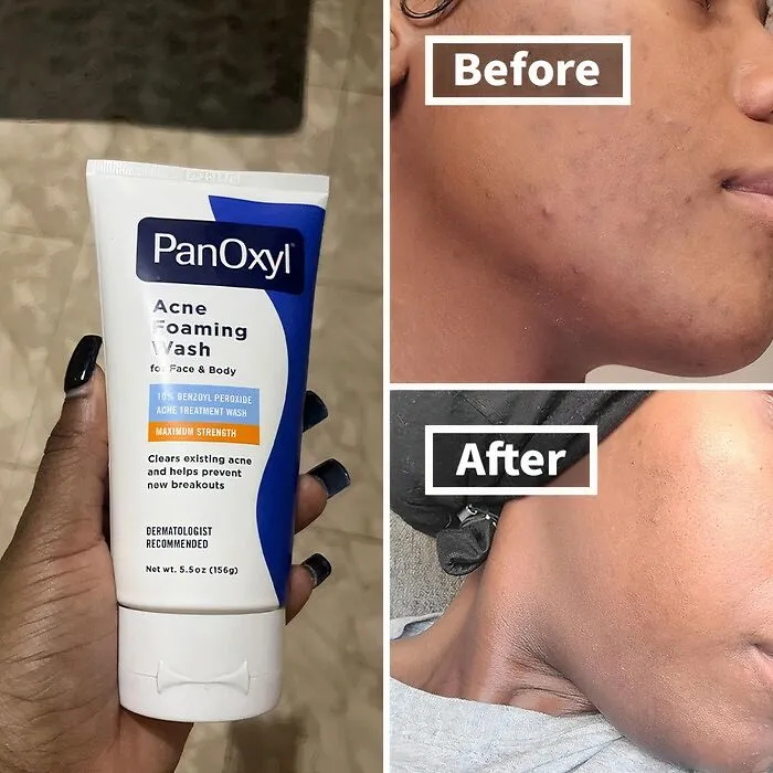 This   <a Style="Display:inline;" Href="Https://Www.amazon.com/Panoxyl-Foaming-Peroxide-Strength-Antimicrobial/Dp/B081kl2qyj?crid=2gv3uuz6bm5cf&dib=eyj2ijoimsj9.f5_wdnbr6kr62ewoihmhvy5vx9oypm27_en-Ldcp1nzs8syf3ciz1aojsziebfwgdrznckek4rgfgjon26wyxvdshd5nqx5b-Dvltduyle302pyrvgrw9e7ffq_bhcavaldpshcgjlr3wvkp-Uihbb7mtutjgnpg6j5cn9jpxhaybgrew_6t2aydybcgyiwjmzjhoui-T5owvng8lin8awhmugxr65ylnks6zdqvonlzoplbwdsfsxmesfvhgvu-6c-Gvcng_uaozpjbtzheutnhrfgc12nn0ha899jmfgo.ehxhodv4bqhyzrj9uvmc-Covxjqz-Iwiuesfxaupvos&dib_tag=se&keywords=acne+soap&qid=1729518378&sprefix=acne+soa%2caps%2c235&sr=8-2-Spons&sp_csd=d2lkz2v0tmftzt1zcf9hdgy&psc=1&linkcode=ll1&tag=bpmonkey-20&linkid=7d297d757801052d807e245393beeca1&language=en_us&ref_=as_li_ss_tl" Target="_blank"><span Style="Font: Inherit; Color: #d74b1f;"> Panoxyl Acne Foaming Wash </Span> Is Like A Superhero For Your Skin, Battling Breakouts And Leaving Your Complexion Clearer Than A Crystal Ball