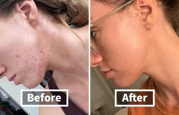 Zap Those Zits Into Oblivion! This   <a Style="Display:inline;" Href="Https://Www.amazon.com/Differin-Adapalene-0-1-Acne-Treatment/Dp/B07l1phsy9?crid=3ub0eu3ah27sh&dib=eyj2ijoimsj9.gkjbnnl5klxf7eyunzmokgxjz3tbej7jts6qzug_a9pkssp3kn5j-Gvhbtrlpg3oarxwkhfoaczfmrupznbhsbuc5ee6qucg0xbtwsltdo-Dv5vjraygpasjblrcgupaurnqvy07xlrvyqovonx9uq-Npop3wbt_hch8ck6e0csky8zjqtedrcn7esrctfsqaqdptrlwcd9ardetrcbeczcyea8uuou0bfrytvklqpm-0aflr-Qjmbtk06xtnimfpgigbm8kopufrukfhhwrb_n4qlmyjyckfnwog9o0ieu.dtktcrlxzqtbcnr20moverngiiux6zyfbshsvwhombu&dib_tag=se&keywords=acne+cream&qid=1729518810&rdc=1&sprefix=acne+crea%2caps%2c234&sr=8-1-Spons&sp_csd=d2lkz2v0tmftzt1zcf9hdgy&psc=1&linkcode=ll1&tag=bpmonkey-20&linkid=93e1448478c820c29ae2469d1029d2fd&language=en_us&ref_=as_li_ss_tl" Target="_blank"><span Style="Font: Inherit; Color: #d74b1f;"> Acne Treatment Gel </Span> Is The Spot Treatment That Will Banish Blemishes And Have Your Skin Looking Clearer Than A Freshly Cleaned Mirror