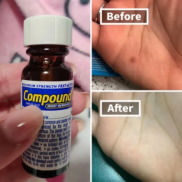 Warts Cramping Your Style? This   <a Style="Display:inline;" Href="Https://Www.amazon.com/Compound-Acting-Liquid-Salicylic-Remover/Dp/B000gckcvy?crid=pr6cl5oe6n03&dib=eyj2ijoimsj9.k8hixq236qxwlidzcdpjbd6poknfl86almpbvltnsjkmy99ijxkdpfhrmtlfz2fied6v88x3r6eskgupciriwhhkejailk6u5xu_hvcdhrrebk8pq_wiz0ljubw5eb9ns5tsppqkazyp6fmon9bakkqhxsol1_xps8jt3rwhqwnlatuxpk24983p6sjekeoeohjmvwxhy8s5hti4ageu-Pu45ovmes2qhzukd9gvrplfm2bdtgozmsn6i0vuc_ucsloyjuit-75uf5mnfp4j4slvuwgpfktxoyihdarc7zm.zlruxga4tvzyotg0lk0dfm7v3a7zblt6yfcoaoo4vz4&dib_tag=se&keywords=wart+remover+ointment&qid=1729575984&sprefix=ward+rem%2caps%2c866&sr=8-15&linkcode=ll1&tag=bpmonkey-20&linkid=5e4609391736278231276159ea699656&language=en_us&ref_=as_li_ss_tl" Target="_blank"><span Style="Font: Inherit; Color: #d74b1f;">liquid Wart Remover</Span> Will Banish Those Pesky Bumps And Have You Feeling Confident In Your Own Skin Again