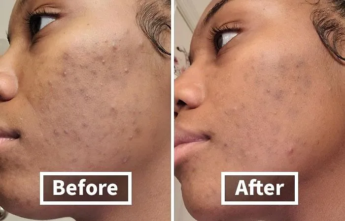 Breakouts Got You Feeling Like A Pizza Face Emoji?   <a Style="Display:inline;" Href="Https://Www.amazon.com/Panoxyl-Foaming-Peroxide-Strength-Antimicrobial/Dp/B081kl2qyj?ie=utf8&linkcode=ll1&tag=bpsparrow-20&linkid=33062a6007a2fdf636d49af0bc8cc5d2&language=en_us&ref_=as_li_ss_tl" Target="_blank"> <span Style="Font: Inherit; Color: #d74b1f;"> Panoxyl Acne Foaming Wash </Span> Is Like A Superhero For Your Skin, Battling Blemishes With Maximum-Strength Benzoyl Peroxide