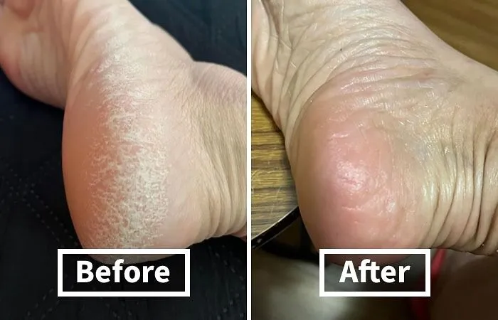 Calluses Got Your Feet Feeling Like You Walked On Hot Coals? This   <a Style="Display:inline;" Href="Https://Www.amazon.com/Lee-Beauty-Professional-Strength-Pedicure/Dp/B01ncmjpoq?ie=utf8&linkcode=ll1&tag=bpsparrow-20&linkid=1bb1a4b57d9bda539f52128886e88eaf&language=en_us&ref_=as_li_ss_tl" Target="_blank"><span Style="Font: Inherit; Color: #d74b1f;"> Lee Beauty Professional Callus Remover </Span> Will Have Your Feet Smoother Than A Baby's Bottom