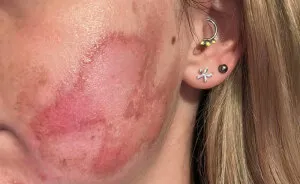 "Horrific": Woman Suffers Second-Degree Burns After Getting Popular Beauty Procedure