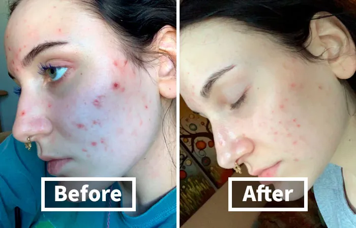 "I wish I could remember which brand of face cream I used but it ate a hole in the skin on my cheekbone. After a year it is still discoloured." - <span Style="Font:inherit;color:#808080"> implodemode</Span>