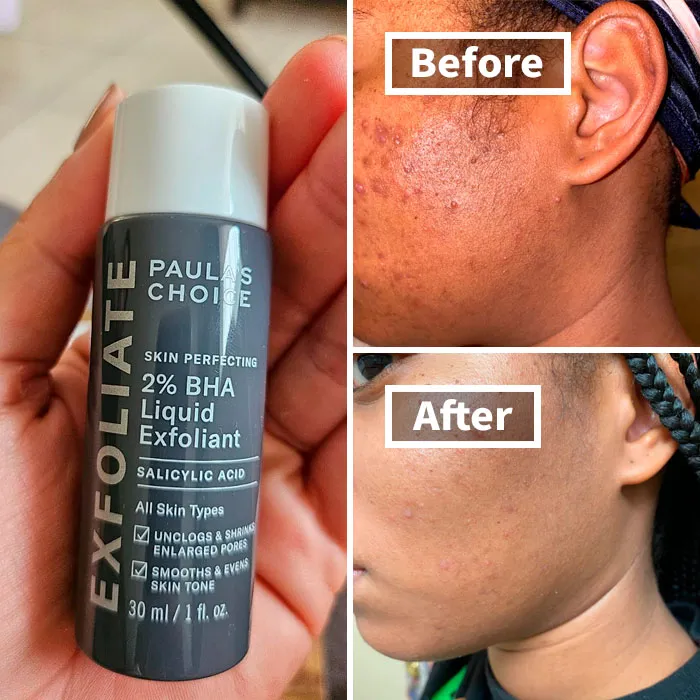 "Started using retinol right before visiting my boyfriend’s family and I’m purging like a motherf***er" - <span Style="Font:inherit;color:#808080"> serketboard</Span>