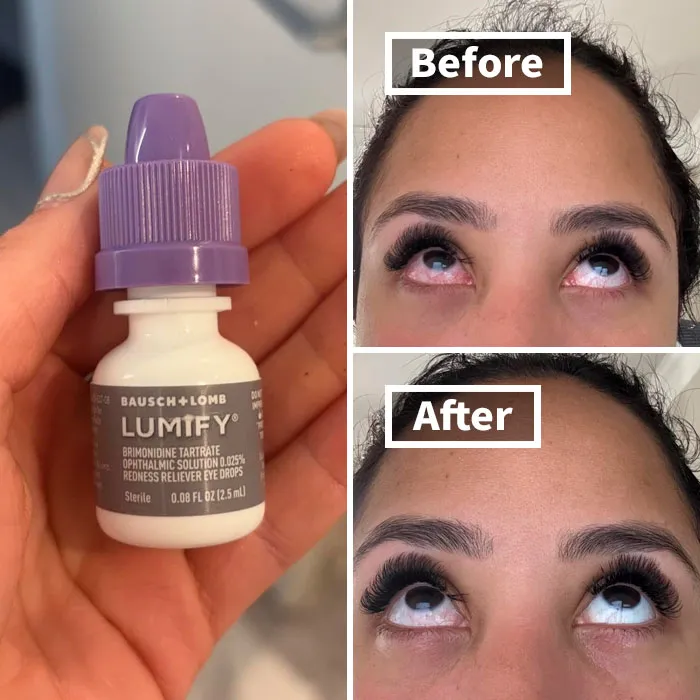 Say Goodbye To Pink Eyes With The <a Style="Display:inline;" Href="Https://Www.amazon.com/Lumify-Redness-Reliever-Drops-7-5ml/Dp/B07bvyzl88?crid=150v53r230gyt&dib=eyj2ijoimsj9.qtplk5iaglbewnlgtohndzhdvrqcojkckjrl3bf_h0zckhzj19-Tycfmbyyp_u7dkxbh9ktxq83-W6yuwgnhgiq9r1n2f3aztmvl55qrheuw0hua-K4mpqnfh_xtlbxdoxjwu4fs50esst1fum6zisymtfexbhlkoymtwmhb9vbtbjgaz78hiktjqfs2euoygizg3pa1ktgbemzzwek0cgr-S71bm3rj0uvosjd1xkwnlpuc43y1ltwjm9zqpeirhyuw1cnf6phpw8ewnrm_92iqa17gur4hh8wqg8oonfy.1lv40h_b8gz06i4e8zstmkwm-4_4rfnfjcnftcgeio8&dib_tag=se&keywords=eye%2bdrops&qid=1729850587&sprefix=eye%2bdr%2caps%2c250&sr=8-4-Spons&sp_csd=d2lkz2v0tmftzt1zcf9hdgy&th=1&linkcode=ll1&tag=bpfrog-20&linkid=c34f966835ccab046c40c1da332b0eff&language=en_us&ref_=as_li_ss_tl" Target="_blank"><span Style="Font: Inherit; Color: #d74b1f;"> Lumify Redness Reliever Eye Drops</Span> - Temporary Relief From Winter Woes!