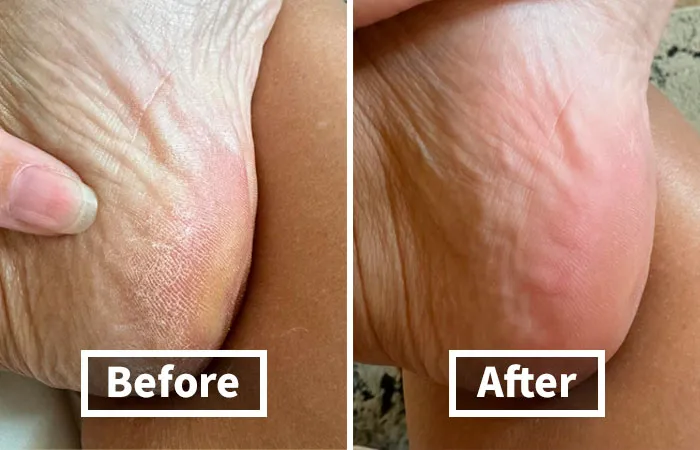 Smooth Out Rough Winter Heels With The Gentle Yet Effective <a Style="Display:inline;" Href="Https://Www.amazon.com/Foot-File-Scrubber-Callus-Remover/Dp/B09jpdsf9h?dib=eyj2ijoimsj9.oxnthu_qsi2ewsknwotehlnlk6f-Xvsag50e_i-Idb-E-Twpobb_rfdpluw5zul1ednmepyjg_risqjpucpbgnggkqtef-U_ue_b90ur_27zkoee3eb4lautnagkwihfn2uaqvx7hseugejjqsgvwzvfitoxho3dfeolnl0issd4c5yw5_qwd0zs-Yn-Fb20fhmx5bwisdvqbkduaqazjyzn6t4flvyjrylq0tfkx13lphtn3zogclexcwwyubkimnry6el3sfq3e_3spee666yarcvaqwwvkyis92uywso.f1atgwt_vbfvfx_i3_lwiaeguvfciscq9rzjgiopmom&dib_tag=se&keywords=foot%2bfile&qid=1729858890&sr=8-1-Spons&sp_csd=d2lkz2v0tmftzt1zcf9hdgy&th=1&linkcode=ll1&tag=bpfrog-20&linkid=86e4709221760f6519f45a35513ae382&language=en_us&ref_=as_li_ss_tl" Target="_blank"><span Style="Font: Inherit; Color: #d74b1f;"> Glass Foot File Callus Remover</Span>