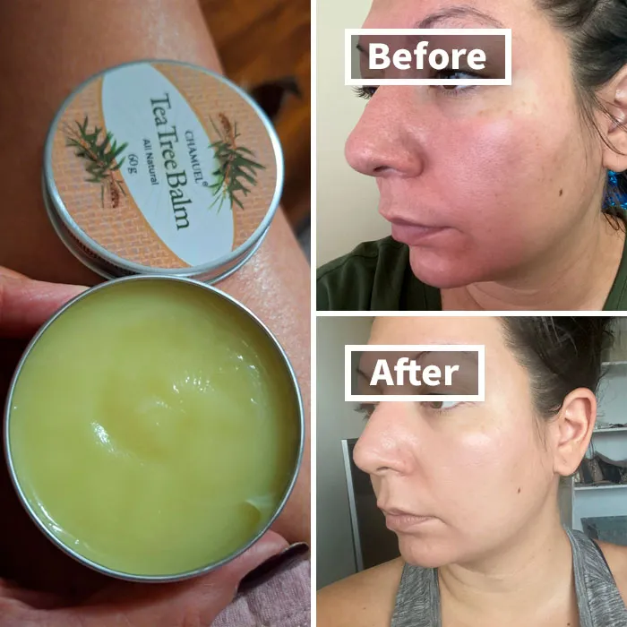 Itch, Meet Relief With The <a Style="Display:inline;" Href="Https://Www.amazon.com/Irritations-Antifungal-Psoriasis-Hemorrhoids-Guaranteed/Dp/B00fknc2wg?crid=1rb0d4xm5zdab&dib=eyj2ijoimsj9.sfpdq09tcksv0mtqtw0q2tcxqq6cxezjsrhurskvk8ntixi3zljkxuyoaje6jkdtygqd9zqvmkhybh70o77n1qar2yghyzwdacbbm1orsbecswv84acbhydzzvddt6c61gyd7lcz1oegewipjcgo6yjjt7c4osziawgs2v6_z6pchydrd3lxck9u5s2ufx5a3wbad95sndalbmjrdizevkw_wv9lugsypxu5rsbxljlppl2ioqefewxrmmk018wxaesu7pizvzj_5pkxl2klhs0wynymgpncqvratc4v_0o.5a45hdqywi2vhwkqt0jq-Oomofbpdc6zohtkqre5yrq&dib_tag=se&keywords=skin+rash+treatment+adult&qid=1729850314&sprefix=rash+skin%2caps%2c257&sr=8-27&linkcode=ll1&tag=bpfrog-20&linkid=b27c666060ade397d3c8a7645bf713cb&language=en_us&ref_=as_li_ss_tl" Target="_blank"><span Style="Font: Inherit; Color: #d74b1f;"> Tea Tree Oil Balm</Span> - Soothing Rashes And Dry Skin