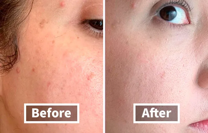 Tackle Winter's Dark Circles And Dry Patches With The <a Style="Display:inline;" Href="Https://Www.amazon.com/L-F-Cosmetics-Hydrating-Concealer-Full-Coverage/Dp/B07zr14wbz?crid=3slbvmw18hg7n&dib=eyj2ijoimsj9.qhdstyqry5zttyhj5cuyitnnyf0u_j0lcbqwfpdnhfykt58eultedhxqkqpu8cvutu5uzqr1_urkuaslwizooew1ueihwoffwxf_m24xxodek2id7nwgmtu4spylotuhoyx1nhdkpp5_ew2f6nhydvgjjrjkzlz1oaq9g4ae4ddtx6flibguumrkcd6_51fiacs7l8v2fib4i5bmhxw-NY2qfv-Zjbj-12jtd0mtu9dvrtior_w9iiuwkj7f9bcdfuwroa6y8f6ifqzvpvynki7_pfmylabjkdudv4nrrbs.eskozzonwptiwevwedxxf4wq-Txb_zgs62iglhkcq0m&dib_tag=se&keywords=blemish%2bconcealer&qid=1729854032&sprefix=blemish%2bconcealer%2caps%2c182&sr=8-8&th=1&linkcode=ll1&tag=bpfrog-20&linkid=90c1be31a41732566c59beb39e87b521&language=en_us&ref_=as_li_ss_tl" Target="_blank"><span Style="Font: Inherit; Color: #d74b1f;"> E.l.f. Hydrating Camo Concealer</Span>