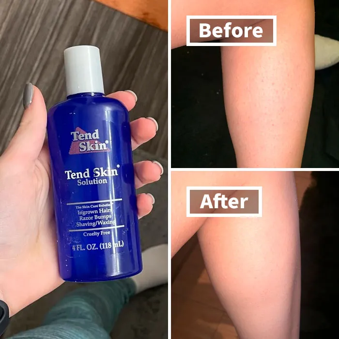 ""Can't remember if it was hair removal cream or bleach, but whatever it was I put it on my upper lip, my skin didn't like it at all, and I had a rashy moustache for about two weeks after." - <span Style="Font:inherit;color:#808080"> ellef86</Span>