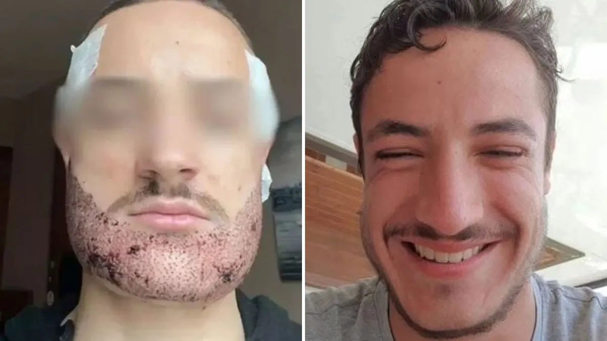 Man Takes His Own Life After Real Estate Agent Poses As Surgeon And Performs Beard Transplant