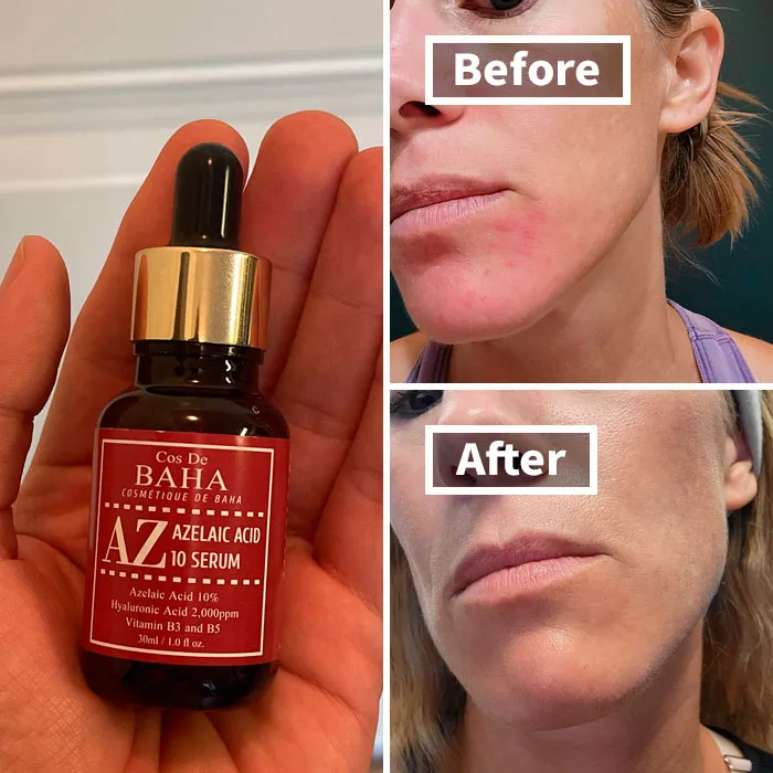 "Vitamin C drops caused my skin to itch horrendously" - <span Style="Font:inherit;color:#808080"> messikah</Span>