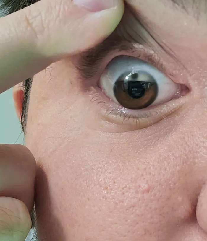 Mi ojo está perdiendo el color poco a poco
