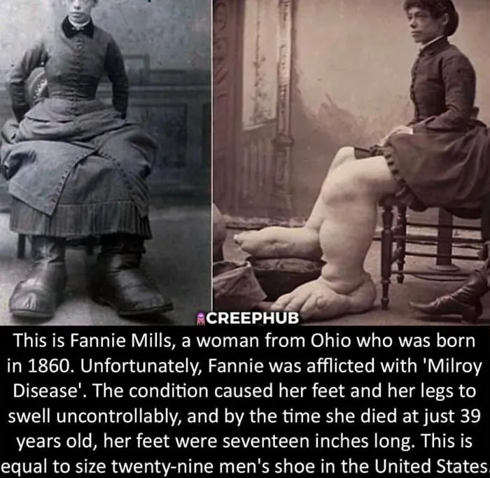 Woman with Milroy Disease, swollen legs and feet, sitting in a 19th-century setting, shared by an Instagram account with weird facts.
