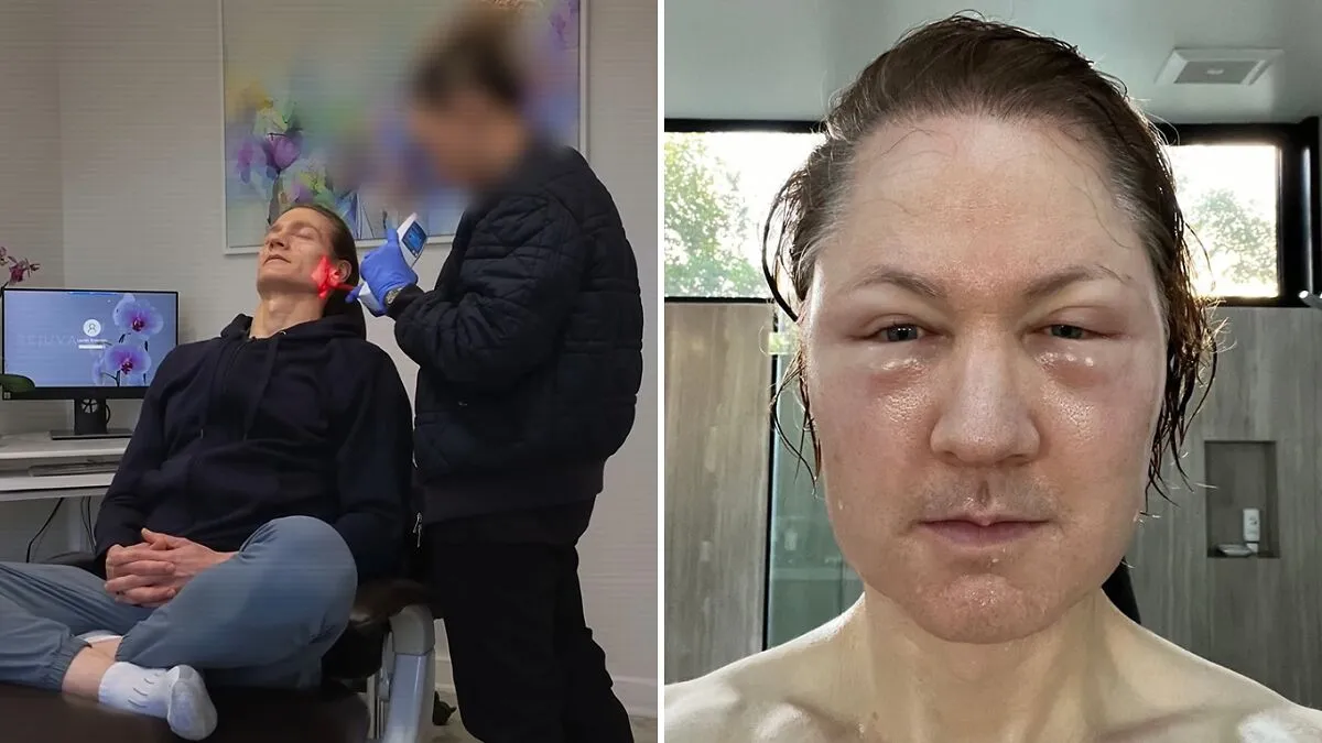 Billionaire Trying To Reverse Aging Injected Fat Into His Face—Reveals “Disturbing” Results