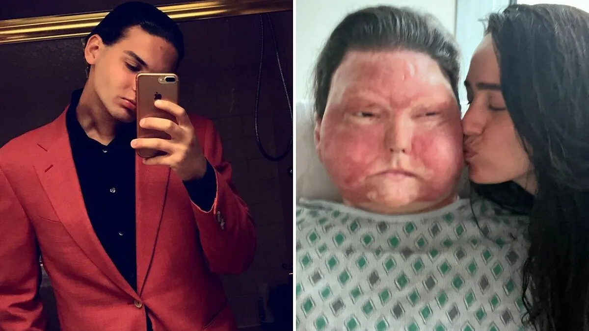 Man Who Had World’s First Face And Hands Transplant Shares Engagement Photos With Fiancée