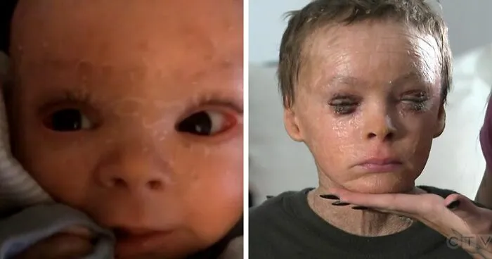 "Absolute Nightmare": 7YO With Rare Condition Sleeps With His Eyes Closed For The First Time