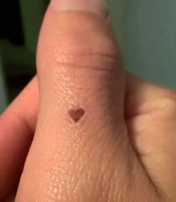 Mi heridita ha curado con una costra en forma de corazón