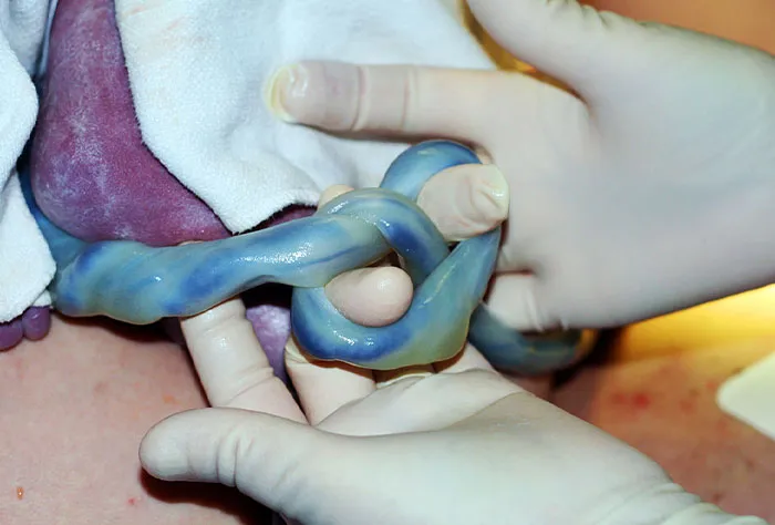 Cuando nació mi hijo tenía un nudo en el cordón umbilical