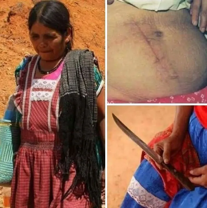 Esta mujer se practicó a sí misma una cesárea tras sufrir durante el parto y no tener acceso a atención médica inmediata. Tanto ella como el bebé sobrevivieron.