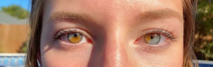 Heterocromía parcial en ambos ojos