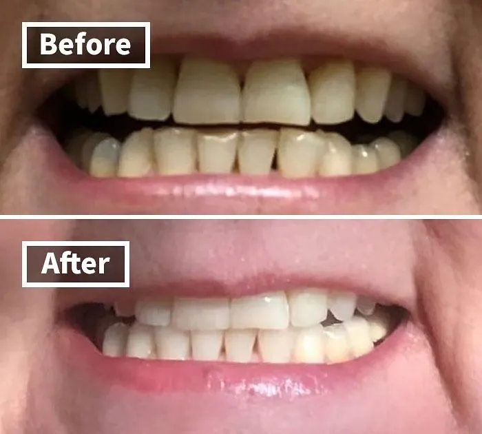 We Shone Bright All Year Long With This Game-Changing <a Style="Display:inline;" Href="Https://Www.amazon.com/Venus-Visage-Effective%ef%bc%86painless-Sensitivity-Travel-Friendly/Dp/B082x2gsgj?ie=utf8&linkcode=ll1&tag=bpstingray-20&linkid=7747e519c8736aa64a34e280d37665e8&language=en_us&ref_=as_li_ss_tl" Target="_blank"><span Style="Font:inherit; Color: #d74b1f;"> Teeth Whitening Pen</Span>