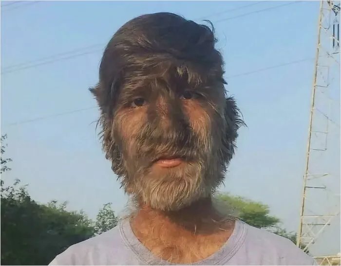 A Man From India Has An Ultra-Rare Condition Called Hypertrichosis, Also Known As “Werewolf Syndrome” 