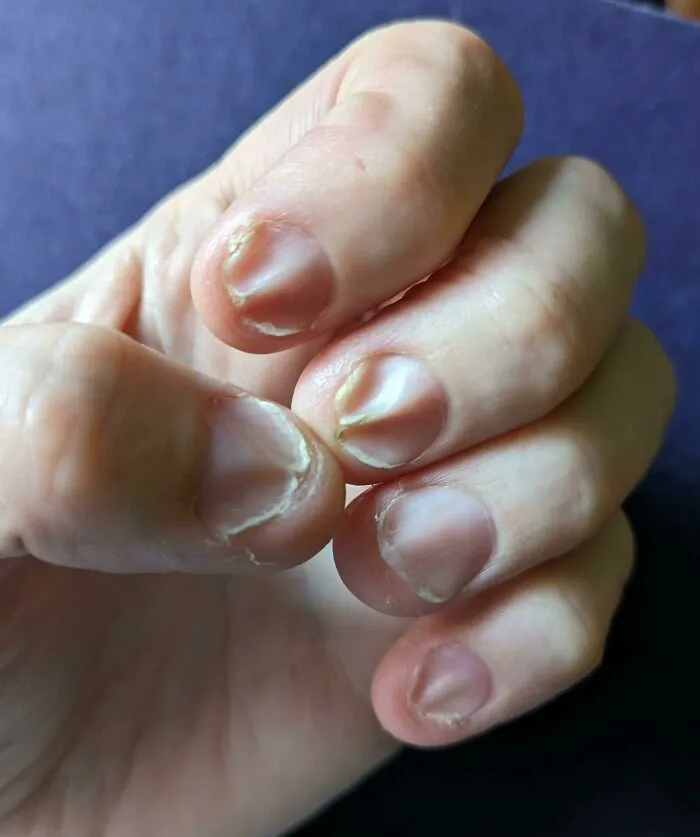 Mis uñas están arrugadas y bastante quebradizas