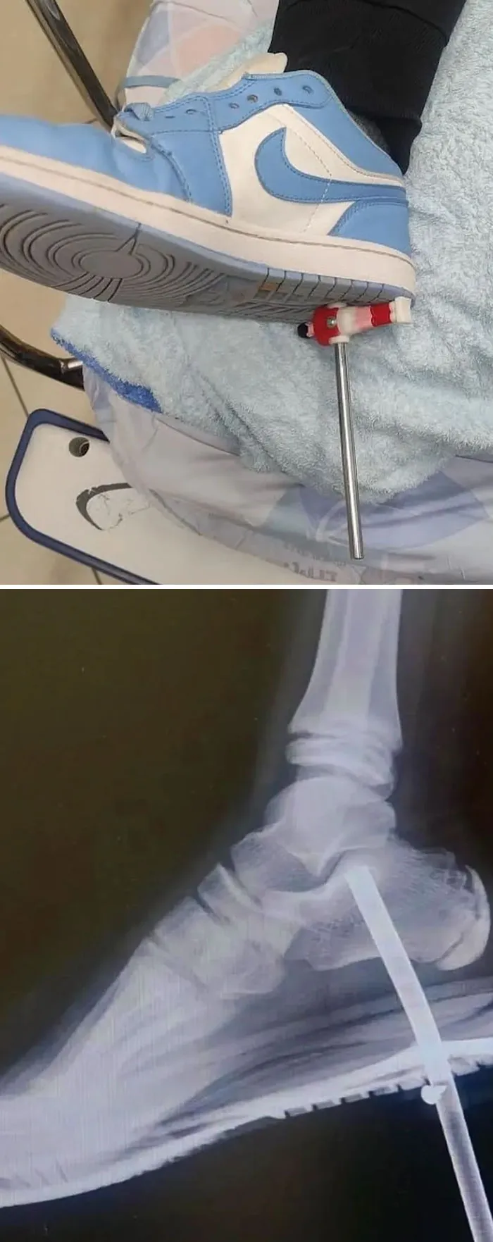 Este joven paciente pisó un poste de futbolín, el poste penetró en la planta de su pie atravesando el zapato y el calcetín.