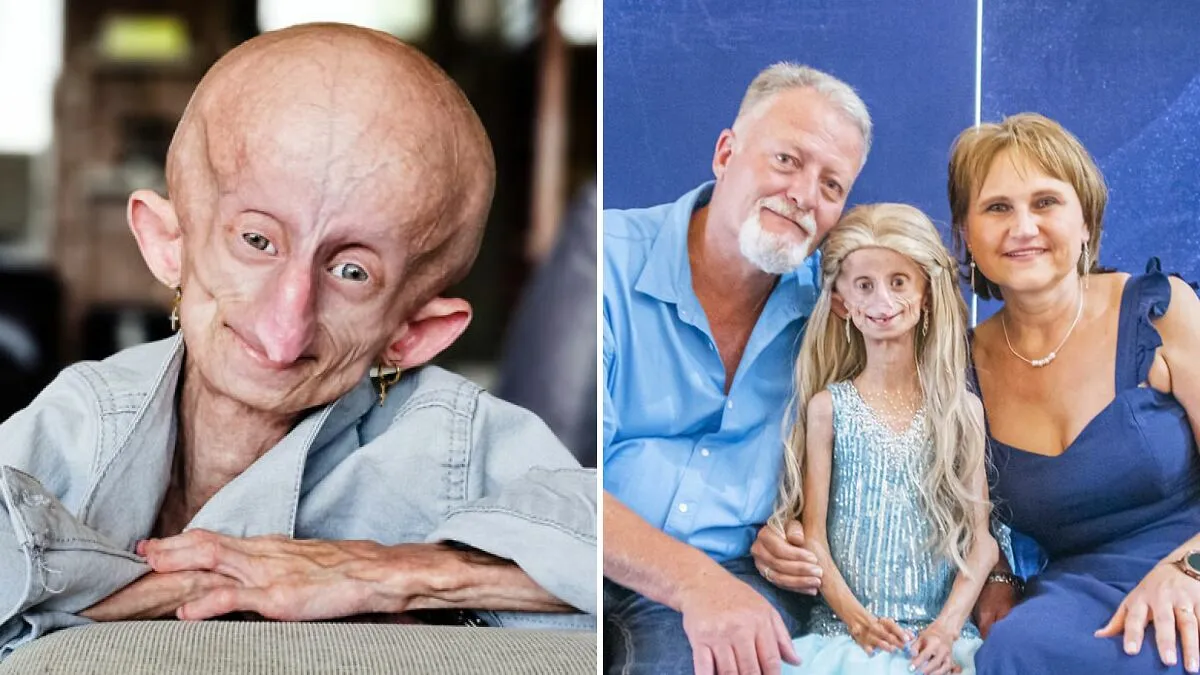 Teen Who Aged 8 Times Faster And Dreamed Of Marrying Passes Away Before Christmas