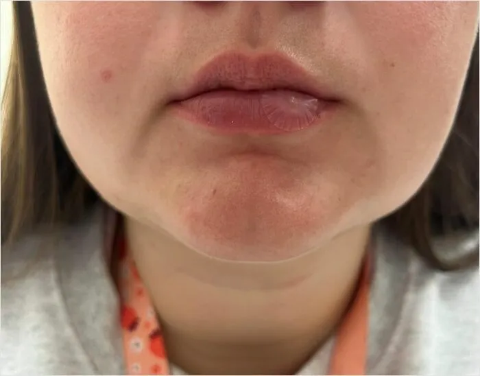 Soothe And Shield Your Skin From The Discomfort Of Fever Blisters With A <a Style="Display:inline;" Href="Https://Www.amazon.com/Mederma-Cold-Discreet-Healing-Patch/Dp/B08mvf9yw1?ie=utf8&th=1&linkcode=ll1&tag=bpantelope-20&linkid=0760bf0fbee85dd83cafe5c94d5964e4&language=en_us&ref_=as_li_ss_tl" Target="_blank"><span Style="Font: Inherit; Color: #d74b1f;"> Fever Blister Healing Patch </Span>, A Protective And Rejuvenating Solution For Fast And Effective Relief