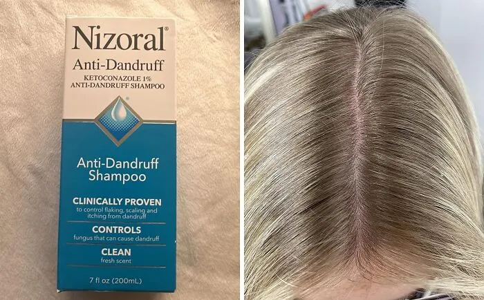 Soothe The Scalp And Calm The Flake With <a Style="Display:inline;" Href="Https://Www.amazon.com/Nizoral-Anti-Dandruff-Shampoo-Ketoconazole-Dandruff/Dp/B00ainmfac?ie=utf8&th=1&linkcode=ll1&tag=bpantelope-20&linkid=bbbddde544736a635e17de441382bdc8&language=en_us&ref_=as_li_ss_tl" Target="_blank"><span Style="Font: Inherit; Color: #d74b1f;"> Nizoral Anti-Dandruff Shampoo </Span>, A Gentle Yet Effective Solution For A Healthier, Happier Head Of Hair