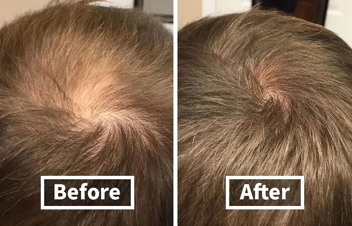Stimulate Hair Growth And Strengthen Your Locks With <a Style="Display:inline;" Href="Https://Www.amazon.com/Rogaine-Minoxidil-Regrowth-Treatment-Thinning/Dp/B0012bnve8?ie=utf8&linkcode=ll1&tag=bpkiwi-20&linkid=e2de725b0b75c381ec4172e64908cf40&language=en_us&ref_=as_li_ss_tl" Target="_blank"><span Style="Font: Inherit; Color: #d74b1f;"> 5% Minoxidil Foam For Hair Loss And Hair Regrowth </Span>, A Clinically-Tested And Effective Solution For Slowing Down Hair Loss And Promoting New Hair Growth