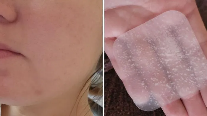 Zap Those Zits And Cover Up With Confidence Using <a Style="Display:inline;" Href="Https://Www.amazon.com/Avarelle-Xl-Hydrocolloid-Blemishes-Carbonfree/Dp/B0797k1kn3?ie=utf8&linkcode=ll1&tag=bpmelon-20&linkid=a5c82db899cdd498a6c2ca7ff4bf0e9c&language=en_us&ref_=as_li_ss_tl" Target="_blank"><span Style="Font: Inherit; Color: #d74b1f;"> Large Acne Patches </Span>. These Ultimate Skin Savers Draw Out Impurities, Reduce Redness, And Hide Blemishes, So You Can Face The Day With Clear Skin And A Clear Conscience