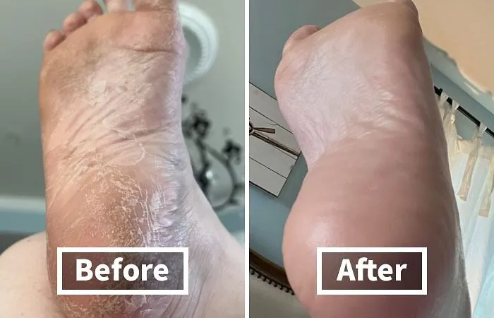 Get Ready To Give Your Feet The TLC They Deserve With The <a Style="Display:inline;" Href="Https://Www.amazon.com/Colossal-Remover-Pedicure-Surgical-Stainless/Dp/B00vpvevsk?ie=utf8&linkcode=ll1&tag=bpmelon-20&linkid=b81619626a05d93aeb6b8793bc5dc625&language=en_us&ref_=as_li_ss_tl" Target="_blank"><span Style="Font: Inherit; Color: #d74b1f;"> Giant Foot File </Span>. This Oversized File Is Perfect For Tackling Tough Calluses And Rough Patches, Leaving Your Feet Feeling Smooth And Pampered