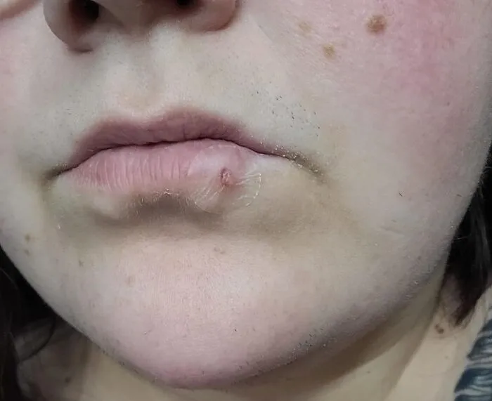 Soothe And Conceal Those Pesky Fever Blisters With The <a Style="Display:inline;" Href="Https://Www.amazon.com/Mederma-Cold-Discreet-Healing-Patch/Dp/B08mvf9yw1?ie=utf8&th=1&linkcode=ll1&tag=bpelk-20&linkid=807f093d03cafac2b5f8d9806fc20ec9&language=en_us&ref_=as_li_ss_tl" Target="_blank"><span Style="Font: Inherit; Color: #d74b1f;"> Fever Blister Discreet Healing Patch </Span>