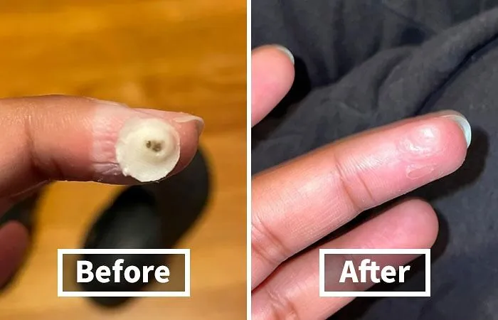 Kick Those Unwanted Warts To The Curb With <a Style="Display:inline;" Href="Https://Www.amazon.com/Compound-Step-Pads-Salicylic-Remover/Dp/B000qwlozw?ie=utf8&th=1&linkcode=ll1&tag=bpelk-20&linkid=6fb46895f2d7b6778685e935559f2903&language=en_us&ref_=as_li_ss_tl" Target="_blank"><span Style="Font: Inherit; Color: #d74b1f;"> Wart Remover Pads </Span>. Quick, Easy, And Discreet, They Help You Take Care Of Those Pesky Growths Without The Need For A Doctor's Visit