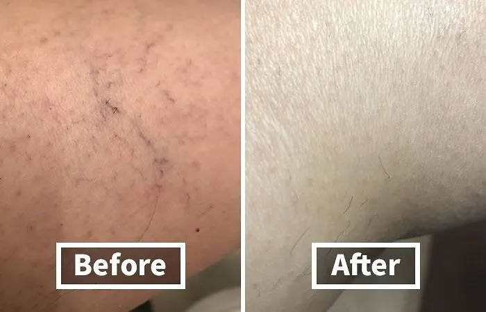 Ease The Ache And Improve The Appearance Of Your Legs With The <a Style="Display:inline;" Href="Https://Www.amazon.com/Varicose-Treatment-Strengthen-Capillary-Circulation/Dp/B08cblbrcl?ie=utf8&th=1&linkcode=ll1&tag=bpelk-20&linkid=cb29c8f3767d31b8f5e02f4d17976b61&language=en_us&ref_=as_li_ss_tl" Target="_blank"><span Style="Font: Inherit; Color: #d74b1f;"> Varicose & Spider Veins Soothing Leg Cream </Span>. Rich And Nourishing, It Helps To Soothe, Calm, And Pamper Your Hardworking Legs