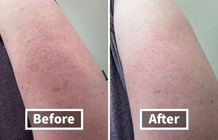 Say Goodbye To Rough, Bumpy Skin With The <a Style="Display:inline;" Href="Https://Www.amazon.com/First-Aid-Beauty-Exfoliant-Keratosis/Dp/B08gns58pq?ie=utf8&th=1&linkcode=ll1&tag=bpelk-20&linkid=3d741e63d984e3c53bb61e1613a4f65a&language=en_us&ref_=as_li_ss_tl" Target="_blank"><span Style="Font: Inherit; Color: #d74b1f;"> Keratosis Pilaris Skin Exfoliator </Span>. This Gentle Yet Effective Exfoliator Smooths Out Kp, Leaving Your Skin Soft, Silky, And Totally Touchable