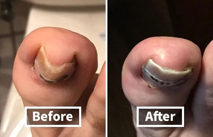 Tackle Pesky Ingrown Toenails From The Comfort Of Your Own Home With The <a Style="Display:inline;" Href="Https://Www.amazon.com/Curvecorrect-Ingrown-Treatment-Correction-Standard/Dp/B007oyke6a?ie=utf8&linkcode=ll1&tag=bpelk-20&linkid=31fff96257e81be96892176b680ef011&language=en_us&ref_=as_li_ss_tl" Target="_blank"><span Style="Font: Inherit; Color: #d74b1f;"> Ingrown Toenail Home Treatment Kit </Span>. No More Painful Digging Or Awkward Doctor Visits!
