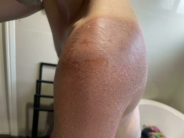 Este es mi recordatorio para que todos uséis protección solar. El sol no se anda con chiquitas este año.