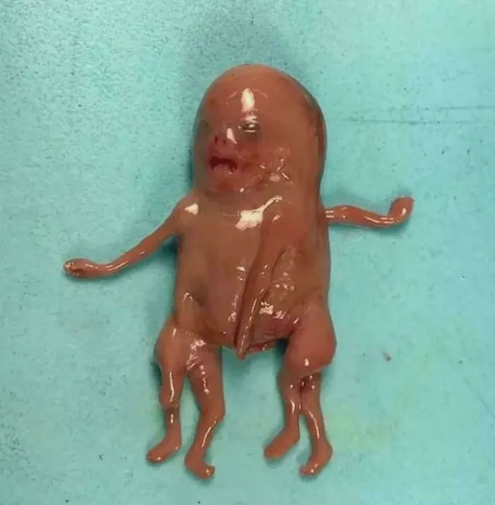 Gemelos siameses cefalópagos de aproximadamente 14 semanas de gestación