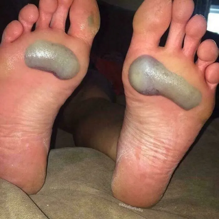 ¡Estas ampollas de sangre se formaron debido al calor extremo mientras jugaba baloncesto durante una hora sobre asfalto en un día con un clima de 38 grados!