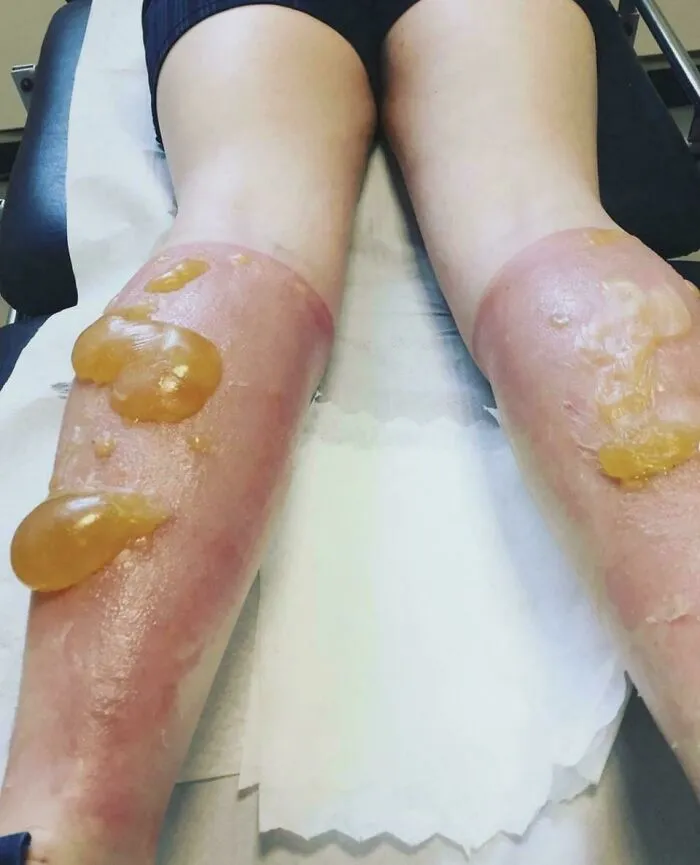 Piernas con quemaduras graves y ampollas, imagen médica impactante y fascinante para estudio clínico avanzado.