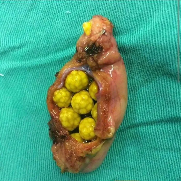 Fotografía médica fascinante y perturbadora mostrando tejido con cuerpos extraños amarillos en fondo quirúrgico verde.