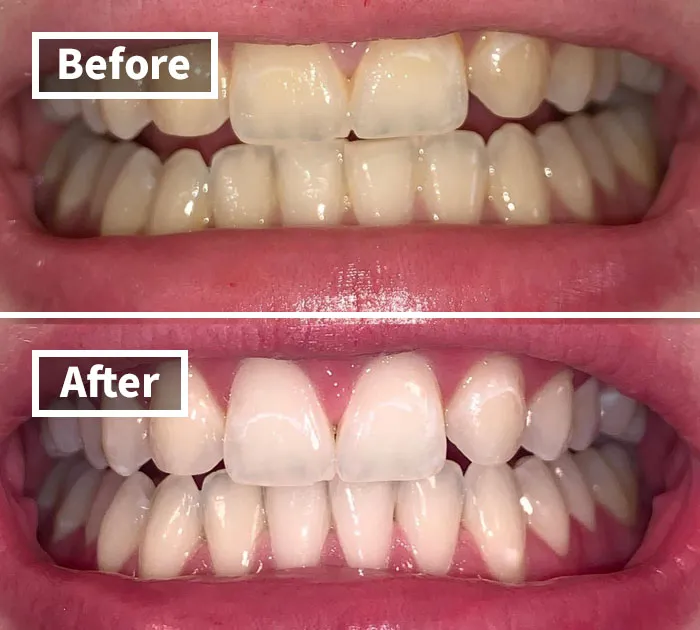 A Brighter Smile, A Brighter You: The <a Style="Display:inline;" Href="Https://Www.amazon.com/Crest-White-Whitestrips-Vivid-Plus/Dp/B077ycc84h?ie=utf8&linkcode=ll1&tag=bpantelope-20&linkid=36c5800f01fa0adf9d0331eeefaef4a9&language=en_us&ref_=as_li_ss_tl" Target="_blank"><span Style="Font: Inherit; Color: #d74b1f;"> Teeth Whitening Pen </Span> Is A Quick And Easy Way To Add Some Sparkle To Your Daily Routine